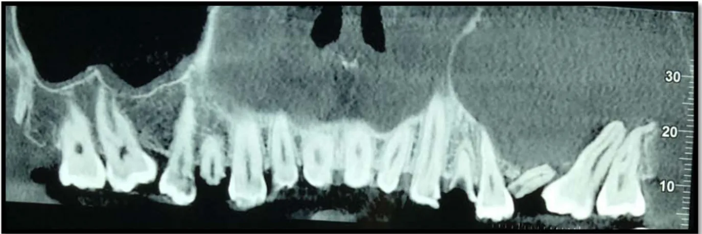 Figure 20 : CBCT : Formation kystique maxillaire supérieure avec déplacement des dents en  rapport 24 et 25 (3)
