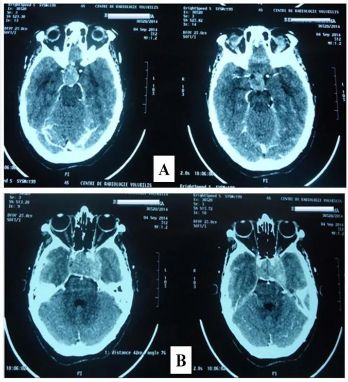 Figure 10: TDM cérébrale en coupes axiales montrant un macroadénome hypophysaire  invasif vis-à-vis du sinus caverneux gauche