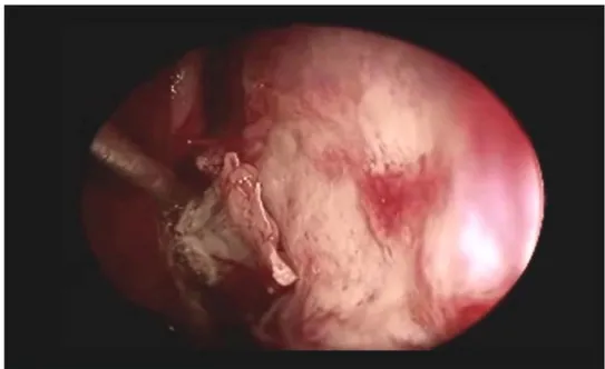 Figure 23  :Repérage du rostre vomérien, décollement de la muqueuse nasale   de son insertion au niveau du rostre vomérien  