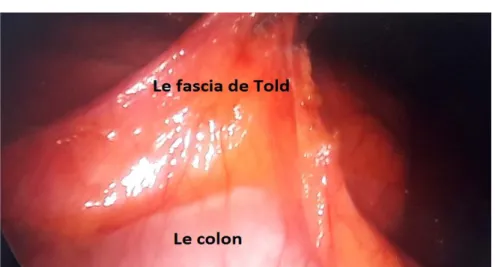 Figure 7 : Décollement colique  o  Section de l’uretère (Figures : 8,9) : 