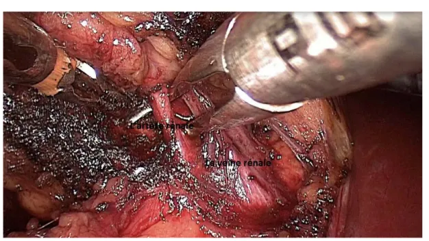 Figure 11 : Dissection et passage du dissecteur en arrière de l’artère rénale droite 
