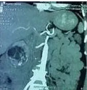 Figure 26 : Coupe frontale d’un angio-scanner montrant un angiomyolipome rénal droit   avec des remaniements hémorragiques
