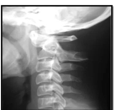 Figure 20  : Radiographie du rachis cervical de profil : aspect de luxation C1C2  avec distance  atloido-axoidienne augmentée (DAA =5 mm )  et recul postérieur de C2 