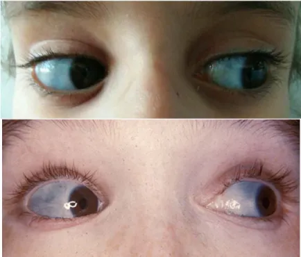 Figure 15 : Sclère bleue 