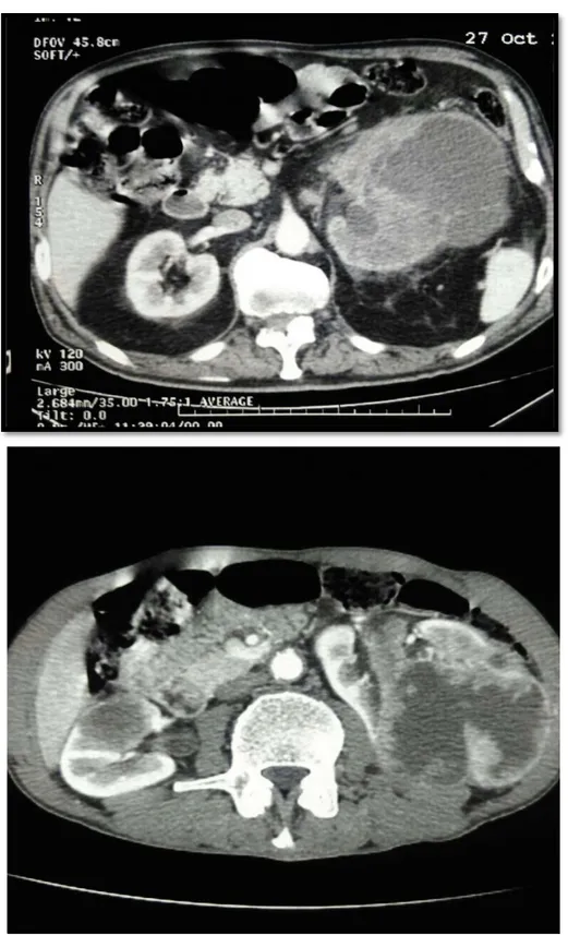Figure 13-14:  TDM abdominale encoupes axiales objectivant : une volumineuse tumeur  rénalegauche nécrosée