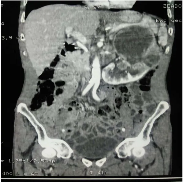 Figure 15 :  TDM abdominale en coupe coronale objectivant : Masse rénale gauche avec  nécrose tumorale et adénopathies hilaires