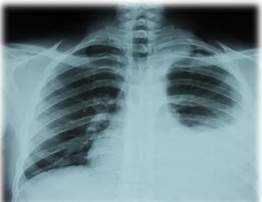 Figure 8: Radiographie thoracique de face :Hémothorax gauche  (Service de Chirurgie Thoracique CHU arrazi