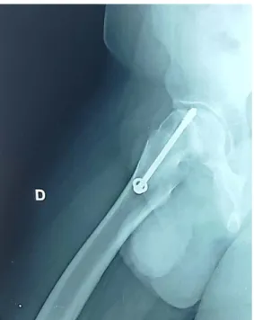 Figure 9: Vis intra articulaire à la radiographie de control d’une EFS traitée par vis après  réduction