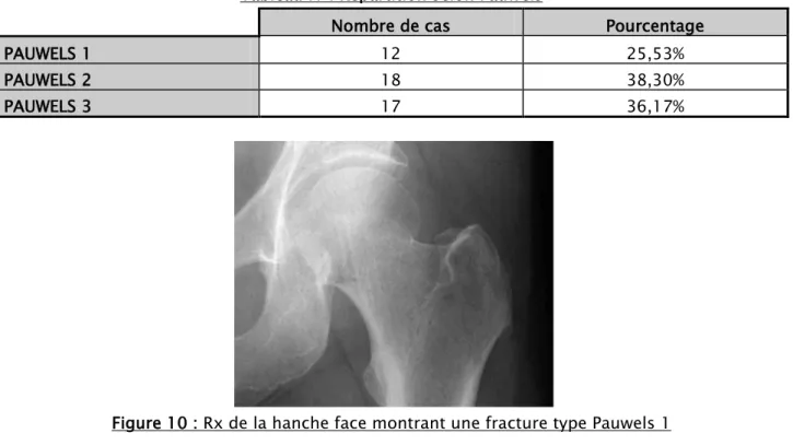Figure 10 : Rx de la hanche face montrant une fracture type Pauwels 1 