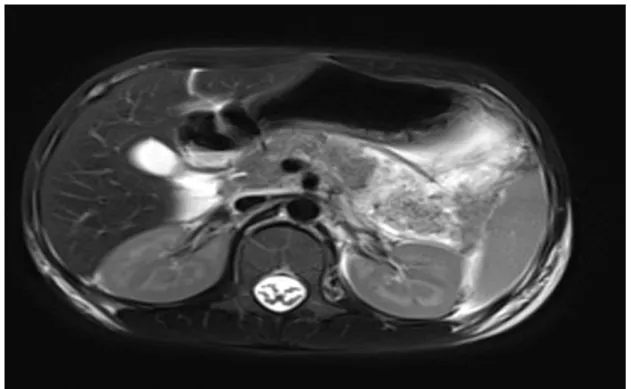 Figure 17 : Image scannographique d’un patient de notre série montrant un pancréas tuméfié, 