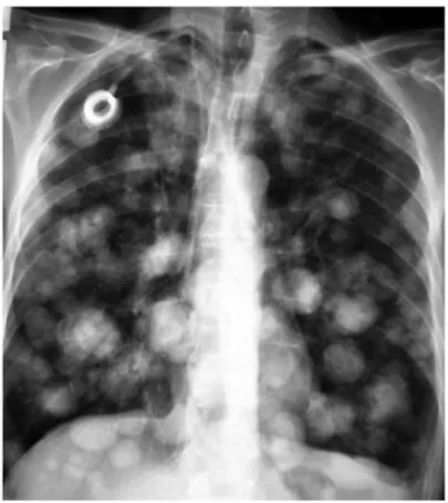Figure 9 : Radiologie du thorax montrant une image en lâcher   de ballon chez un patient de notre étude
