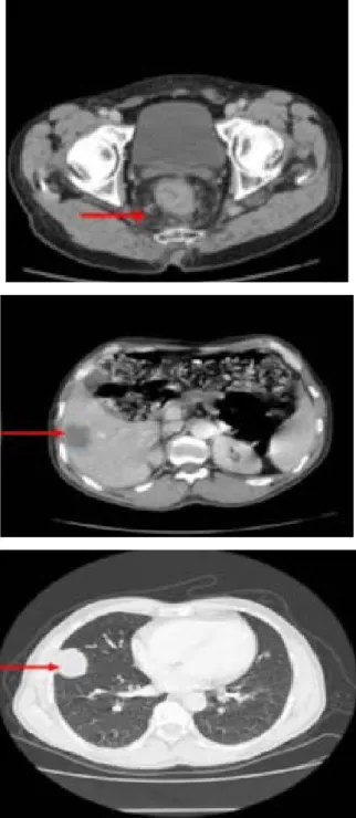 Figure 12 : TDM TAP montrant un cancer du rectum avec des métastases hépatiques  et  pulmonaires Chez un patient de notre étude