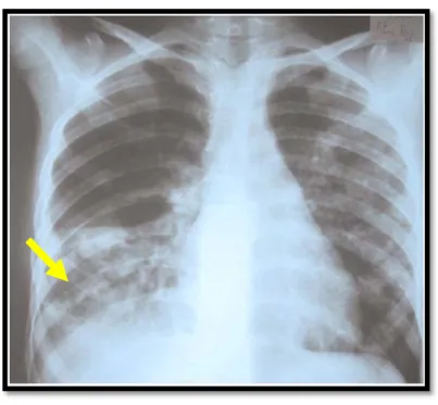 Figure : Pneumonie caséeuse 