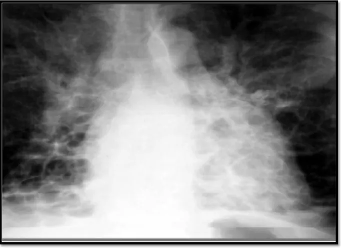 Figure 14: Radiographie thoracique de face montrant une dilatation des bronches de type  kystique