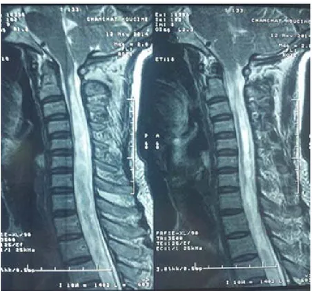 Figure 10 : Coupe sagittale d’une IRM occipito-cervicale en séquence T2 montrant une  malformation Chiari I associée à une syringomyélie de localisation cervico-dorsale 