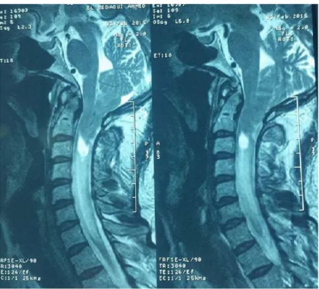 Figure 11 : Coupe sagittale en séquence T2 d’une IRM occipito-cervicale montrant une  malformation Chiari I associée à une syringomyélie cervicale