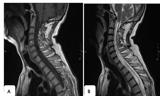 Figure 15: Coupe sagittale d’une IRM occipito-cervicale en hyposignal T1 (A), hypersignal T2 (B)  montrant une cavité syringomyélique centro-médullaire cervico-dorsale étendue de C1 à D11 