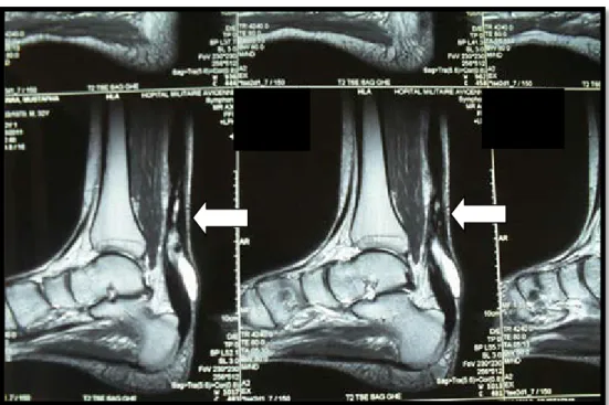 Figure 20 : IRM préopératoire démontrant un defect (flèche) chez un patient de notre série  avec une rupture négligée du tendon d'Achille 