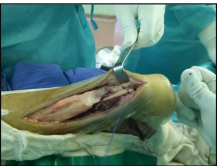 Figure 25: Passage du tendon FHL dans un tunnel de la grosse tubérosité du calcanéum                  