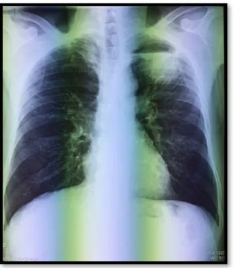 Figure 22:  U Radiographie thoracique de face montrant une opacité apicale lobaire supérieure 