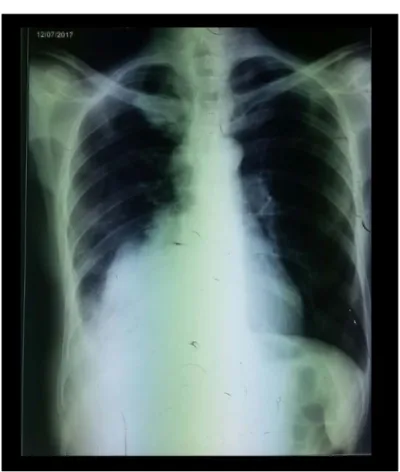 Figure 24 U  : Radiographie thoracique de face montrant une opacité para-cardiaque 