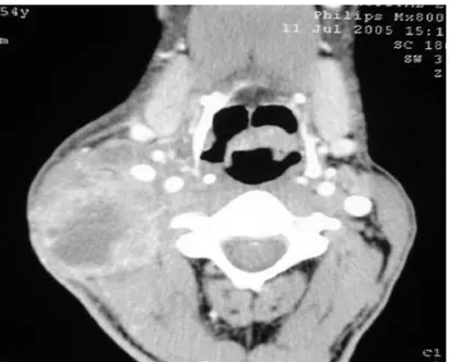 Figure 20: Tumeur de l’épiglotte associée à une volumineuse adénopathie jugulo carotidienne droite 