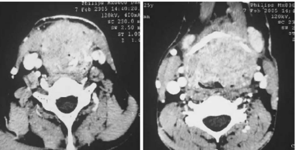 Figure 23 : Processus tumorale intéressant les trois étages localement avancés :carcinome  épidermoide mucco invasif 