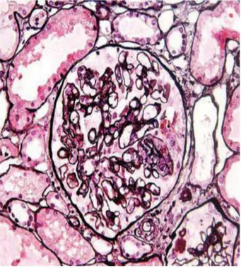 Figure 5: Lupus nephritis class III (A). Light  micrograph showing a glomerulus with  segmental capillary necrosis with sparing of 
