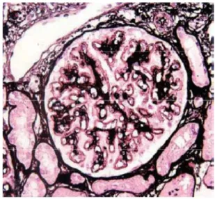 Figure 10: Lupus nephritis class V.  Glomerulus with advanced stage lupus  membranous nephropathy characterized by 