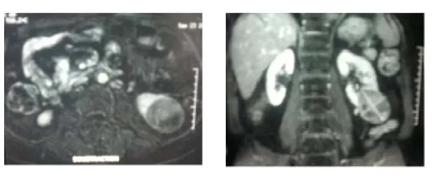 Figure 27-28: IRM abdominale en coupe axiale (27) et coronale (28) montrant une lésion  polaire inférieure gauche de signal mixte hétérogène à développement inférieur exophytique 