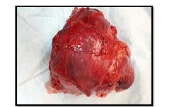 Figure 37:photo d’une pièce opératoire d'un carcinome à cellules claires du rein après  néphrectomie totale élargie