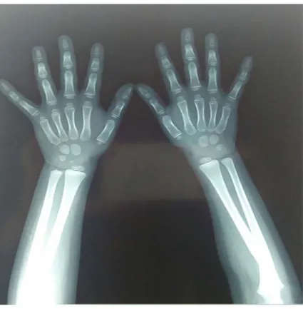 Figure 11 : Radiographie de la main qui montre un âge osseux avancé par rapport à l’âge  chronologique, AO=4ans, AC=3ans (Image de service de pédiatrie A du CHU Med VI) 