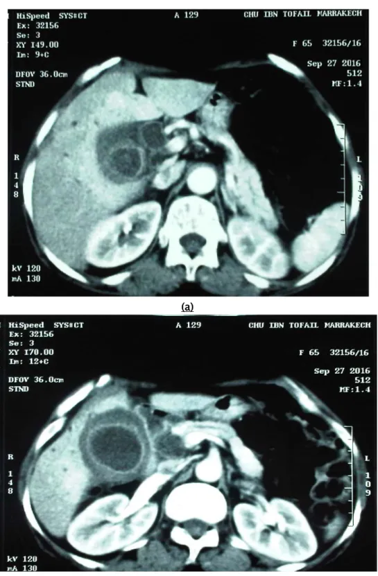 Figure 9 (a+b) : Images d’une TDM abdominale en coupe transversale, montrant une  angiocholite