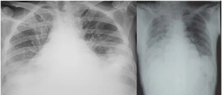 Figure 12: Radiographies du thorax montrant des pneumopathies diffuses