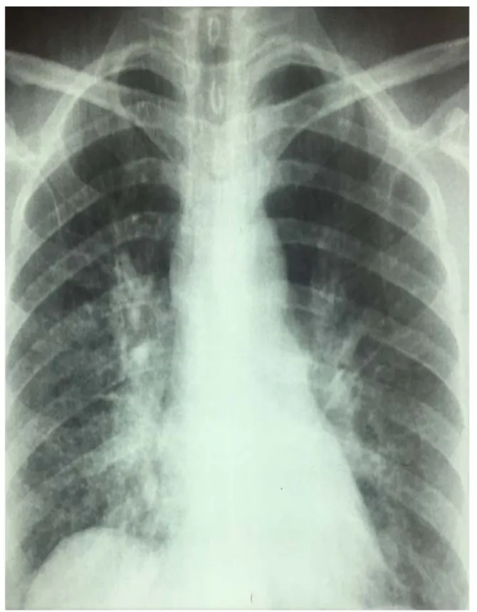 Figure n°8 : Radiographie thoracique  de face : Adénopathies hilaires bilatérales  Stade I  de la sarcoïdose 