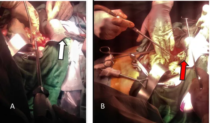 Figure 14 : Abord abdominal pour une résection rectal chez un de nos malades. (A). Deuxième  aide est entre les jambes du patient pour tenir une valve sus-pubienne (flèche blanche) nécessaire 