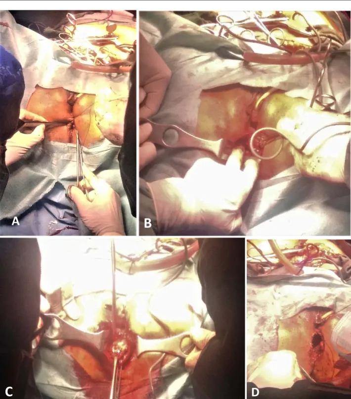 Figure 15 : Phases périnéal de l’AAP chez un patient de notre série. (A). Fermeture de l’anus et  incision péri anale circulaire à environ 2 cm de l’anus