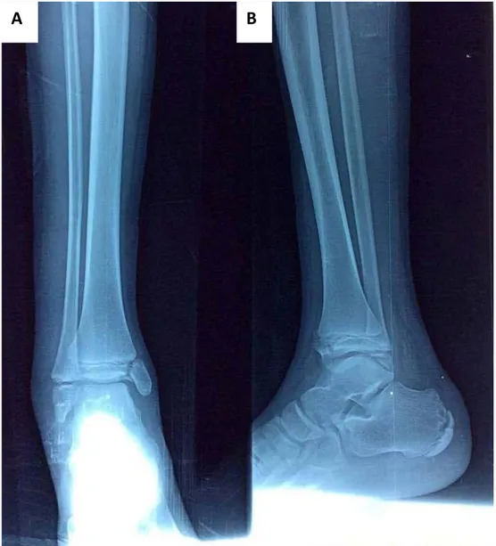 Figure 22 : radiographies de la cheville droite face (A) et profil (B) objectivant une fracture de Mac  Farland (SH III) chez un garçon de 13ans