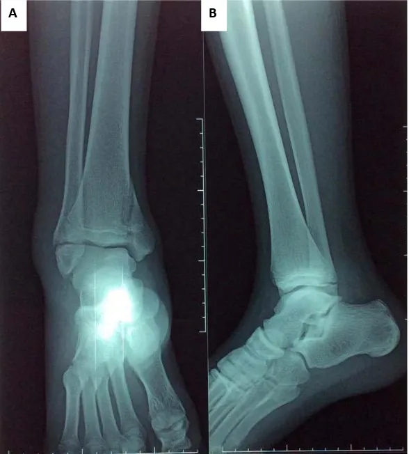 Figure 23: radiographies de la cheville face (A) et profil (B) montrant une fracture de Mac Farland   (SH IV) chez un garçon de 14 ans