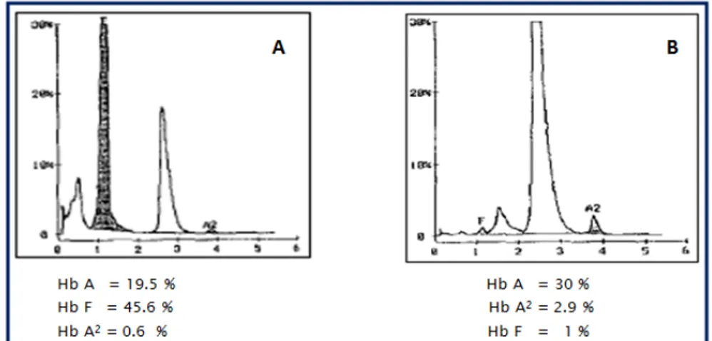 Figure 9: Profil chromatographique d’un sang normal chez un nouveau né (A)   et chez un adulte normal (B) [22] 