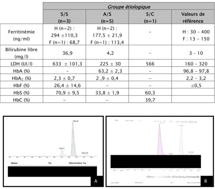 Tableau VII Les résultats des paramètres biochimiques obtenus chez les patients présentant  une hémoglobinopathie S