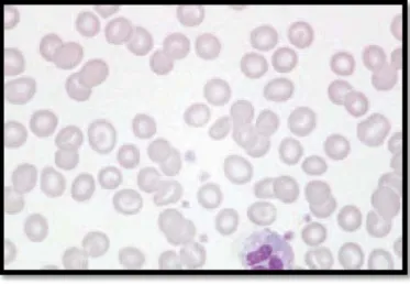 Figure 38 Frottis sanguin qui montre une hypochromie avec des cellules cibles et d'autres  poïkilocytes