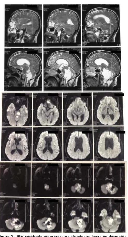 Figure 2 : IRM cérébrale montrant un volumineux kyste épidermoïde   de la fosse cérébrale postérieure