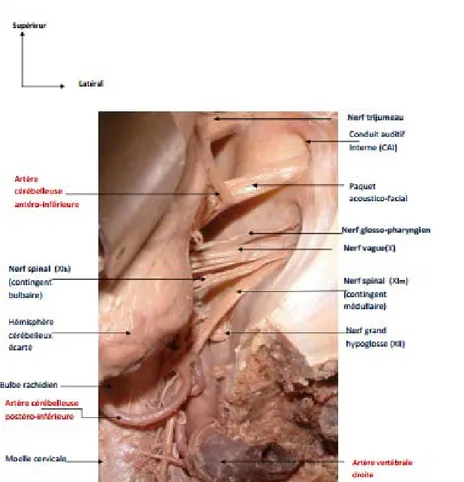 Figure 34: Vue postéro-latérale de l’angle ponto-cérébelleux droit montrant la disposition des  différents éléments vasculo-nerveux de l’A.P.C