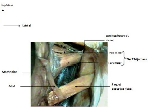 Figure 38: Vue postérieure sous microscope opératoire montrant l’origine  apparente du nerf  Trijumeau (Pars major et Pars minor) 