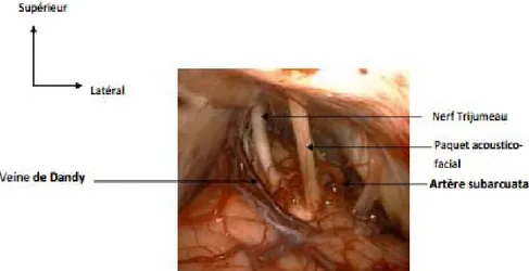 Figure 40: Vue opératoire de l’APC droit prise par voie rétro sigmoïde sous microscope,  montrant la Veine pétreuse supérieure de Dandy [75] 
