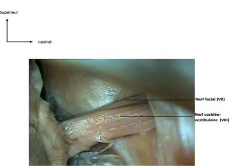 Figure 42: Vue postérieure de l’APC montrant le paquet acoustico-facial  b.2.  L’artère cérébelleuse antéro-inférieure (A.I.C.A) : (Figure 43) 