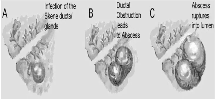 Figure N°9 : Pathogenèse du diverticule uréthral selon les études anatomiques de Routh, appuyée  par Hoffman [16]