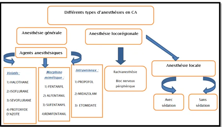 Figure 13 : Les différents types d’anesthésie en chirurgie ambulatoire. 18% 