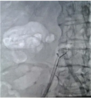 Figure 12 : image avec cathétérisme de l’AFS par la sonde cathéter vertébrale 